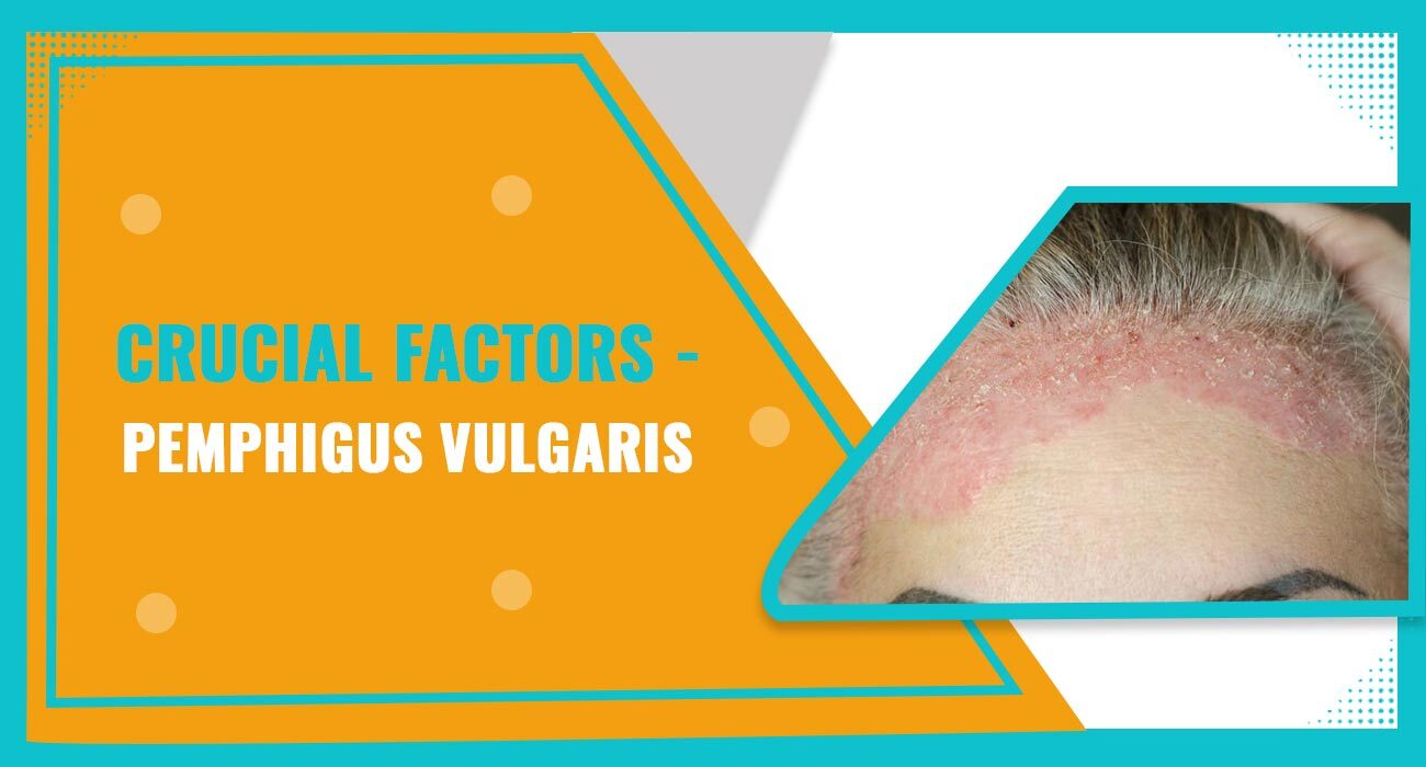 Crucial factors of pemphigus Vulgaris